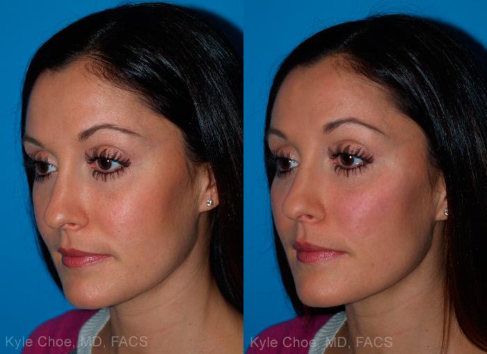 before and after photos in , , Volume Lift in Virginia Beach, VA