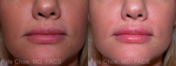 before and after photos in , , Injectable Fillers in Virginia Beach, VA