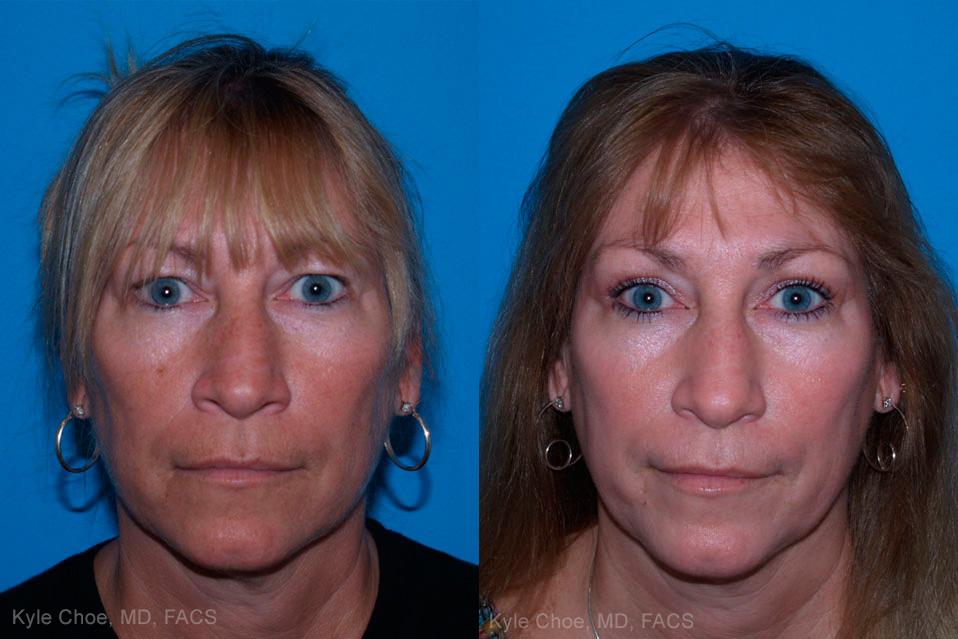  before and after photos in , , Laser Skin Resurfacing in Virginia Beach, VA