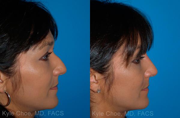  before and after photos in , , Non-Surgical Rhinoplasty in Virginia Beach, VA
