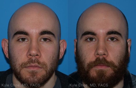  before and after photos in , , Otoplasty in Virginia Beach, VA