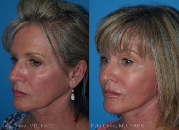 before and after photos in , , Neck Liposuction in Virginia Beach, VA