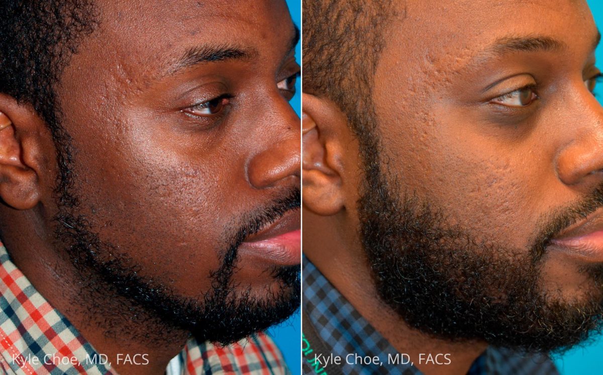  before and after photos in , , Hair Restoration in Virginia Beach, VA