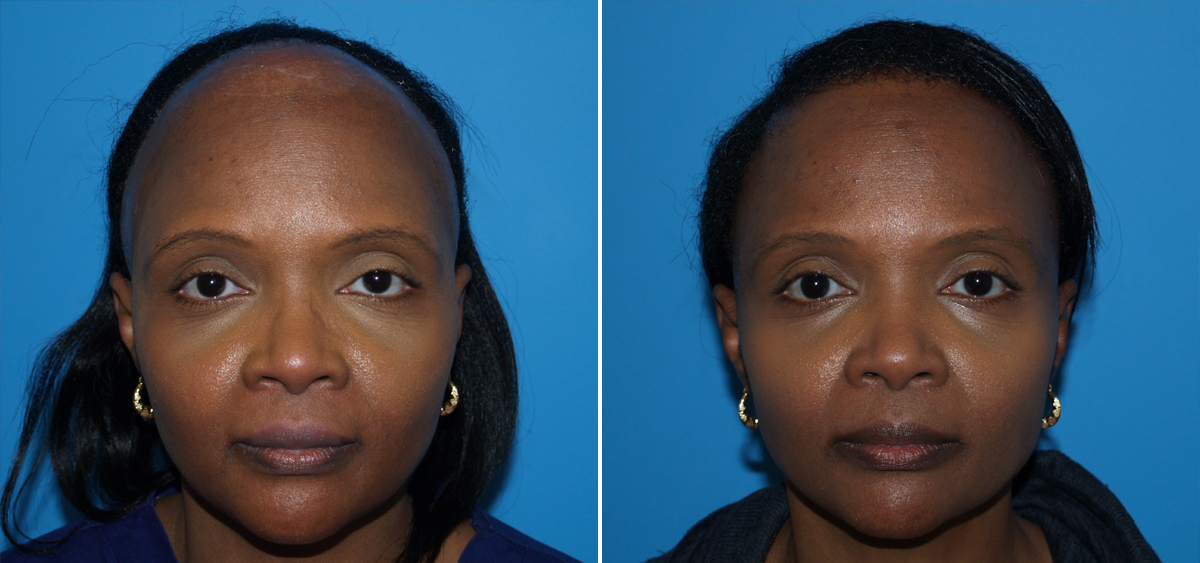  before and after photos for Hair Restoration in Virginia Beach, VA