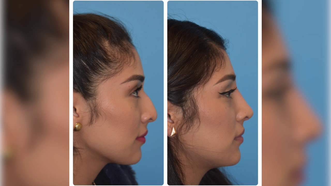 Non-Surgical Rhinoplasty liquid liposuction