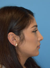 Non-Surgical Rhinoplasty