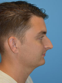 Non-Surgical Rhinoplasty