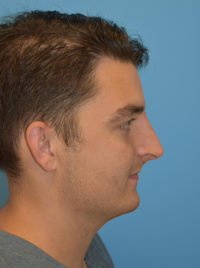 Non-Surgical Rhinoplasty