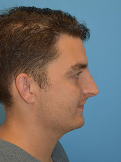 Non-Surgical Rhinoplasty