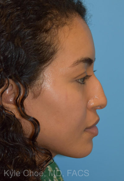 Non-Surgical Rhinoplasty