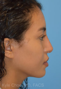 Non-Surgical Rhinoplasty