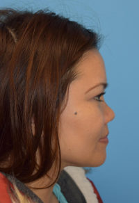 Non-Surgical Rhinoplasty