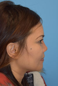 Non-Surgical Rhinoplasty