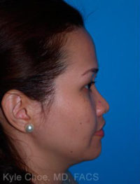 Non-Surgical Rhinoplasty