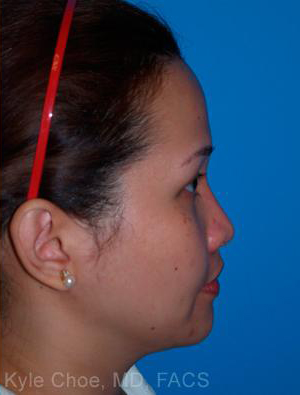 Non-Surgical Rhinoplasty