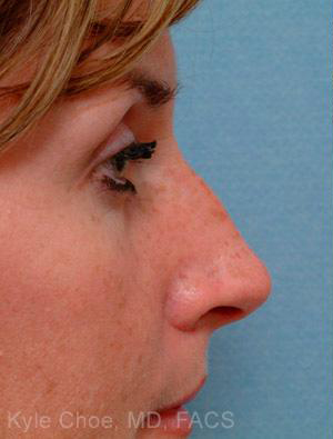 Non-Surgical Rhinoplasty