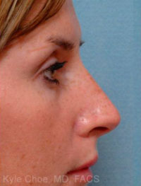 Non-Surgical Rhinoplasty