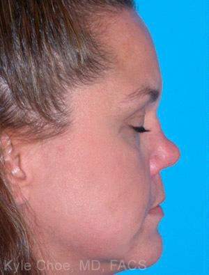 Non-Surgical Rhinoplasty