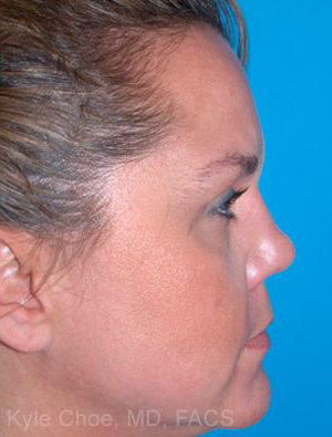 Non-Surgical Rhinoplasty