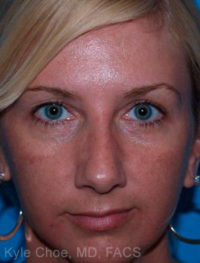 Non-Surgical Rhinoplasty