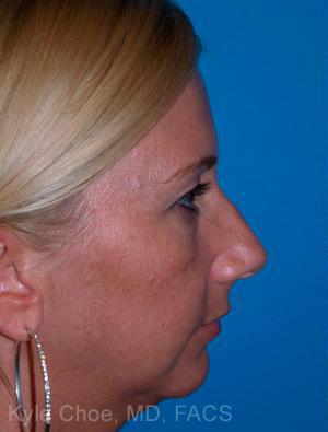 Non-Surgical Rhinoplasty