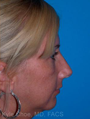 Non-Surgical Rhinoplasty