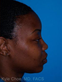 Non-Surgical Rhinoplasty