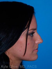 Non-Surgical Rhinoplasty