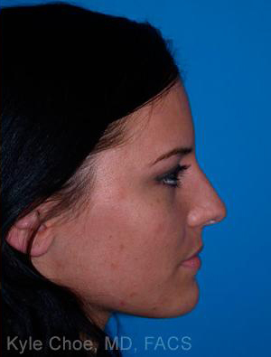 Non-Surgical Rhinoplasty