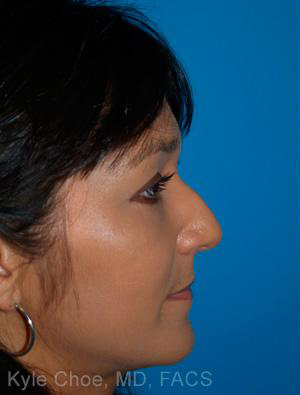 Non-Surgical Rhinoplasty