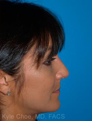 Non-Surgical Rhinoplasty