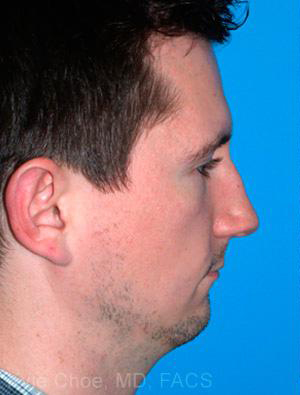 Chin Augmentation