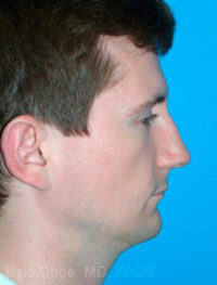 Chin Augmentation