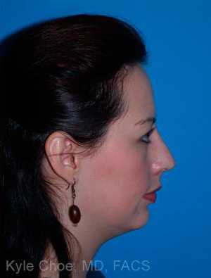 Chin Augmentation