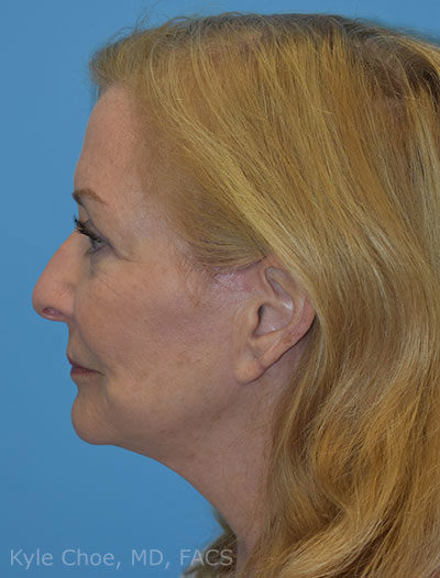 Blepharoplasty (Eyelid Surgery)