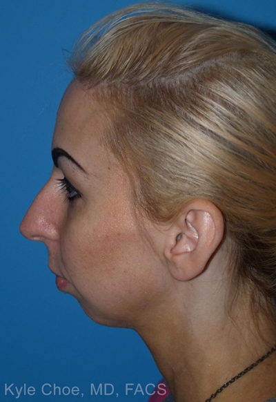 Rhinoplasty