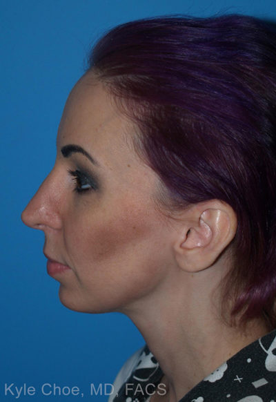 Rhinoplasty