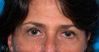 Endoscopic Brow Lift