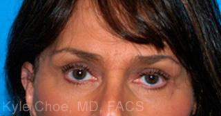 Endoscopic Brow Lift