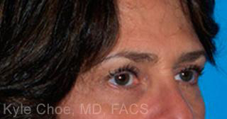 Endoscopic Brow Lift