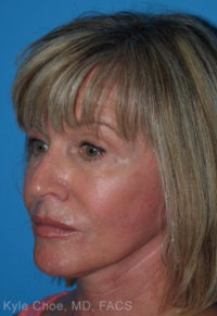 Facelift