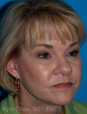 Facelift
