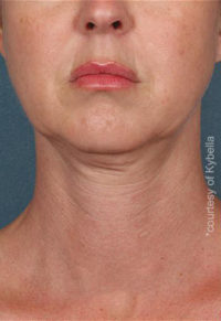 Kybella