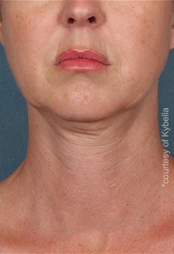 Kybella