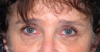 Endoscopic Brow Lift