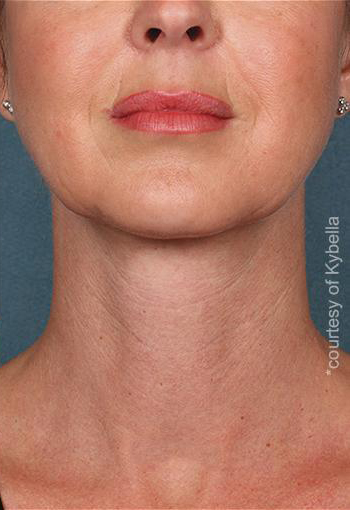 Kybella