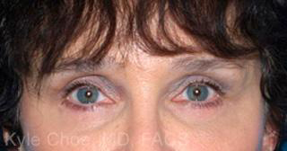 Endoscopic Brow Lift