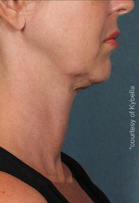 Kybella