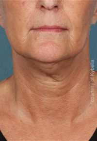 Kybella