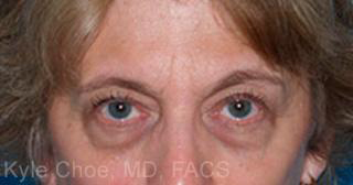 Endoscopic Brow Lift